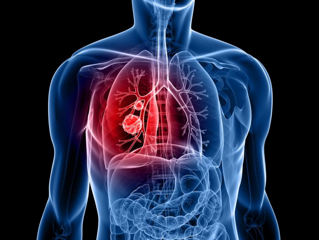 lung cancer specialist singapore